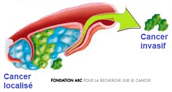 Cancer du col, cancer du sein, breast cancer