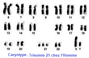 caryotype trisomie 21