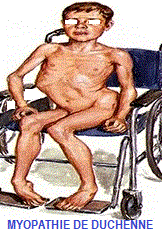 myopathie de Duchenne